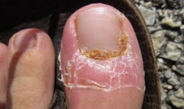 El tratamiento de hongos en las uñas