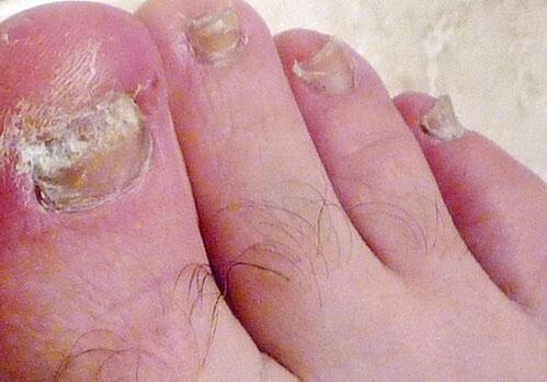 hongos en las uñas de los pies