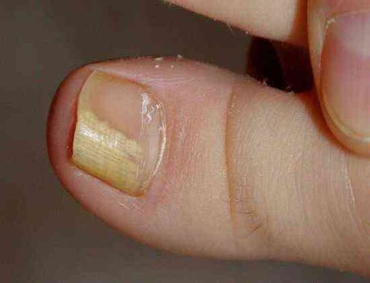 forma lateral distal de hongos en las uñas