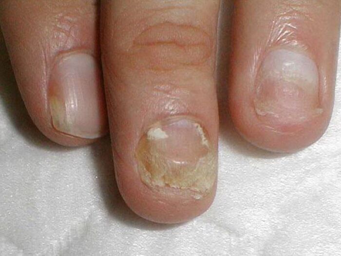 tratamiento de hongos en las uñas candida