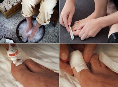 Cocer al vapor los pies y aplicar crema de urea en las uñas afectadas por hongos