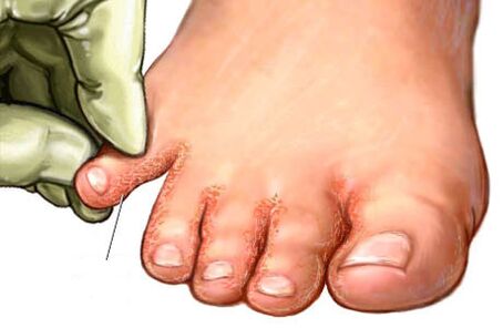 hongo entre los dedos de los pies