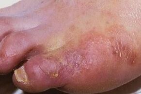 manifestaciones de una infección por hongos en la piel de las piernas