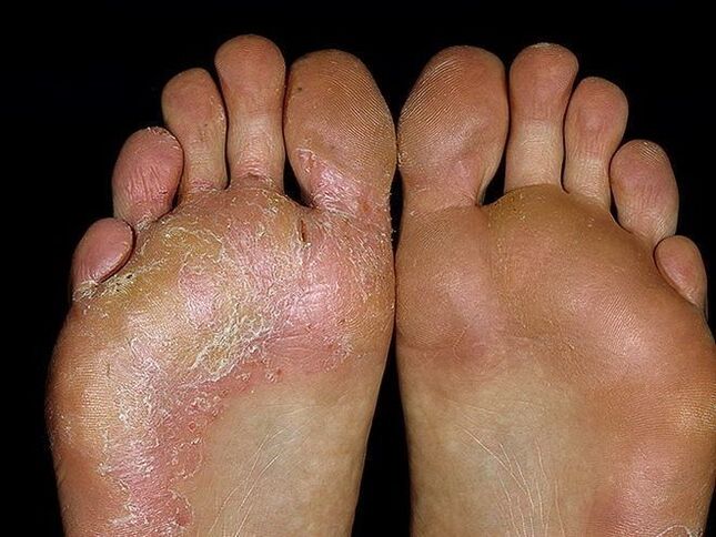 síntomas de un hongo en el pie