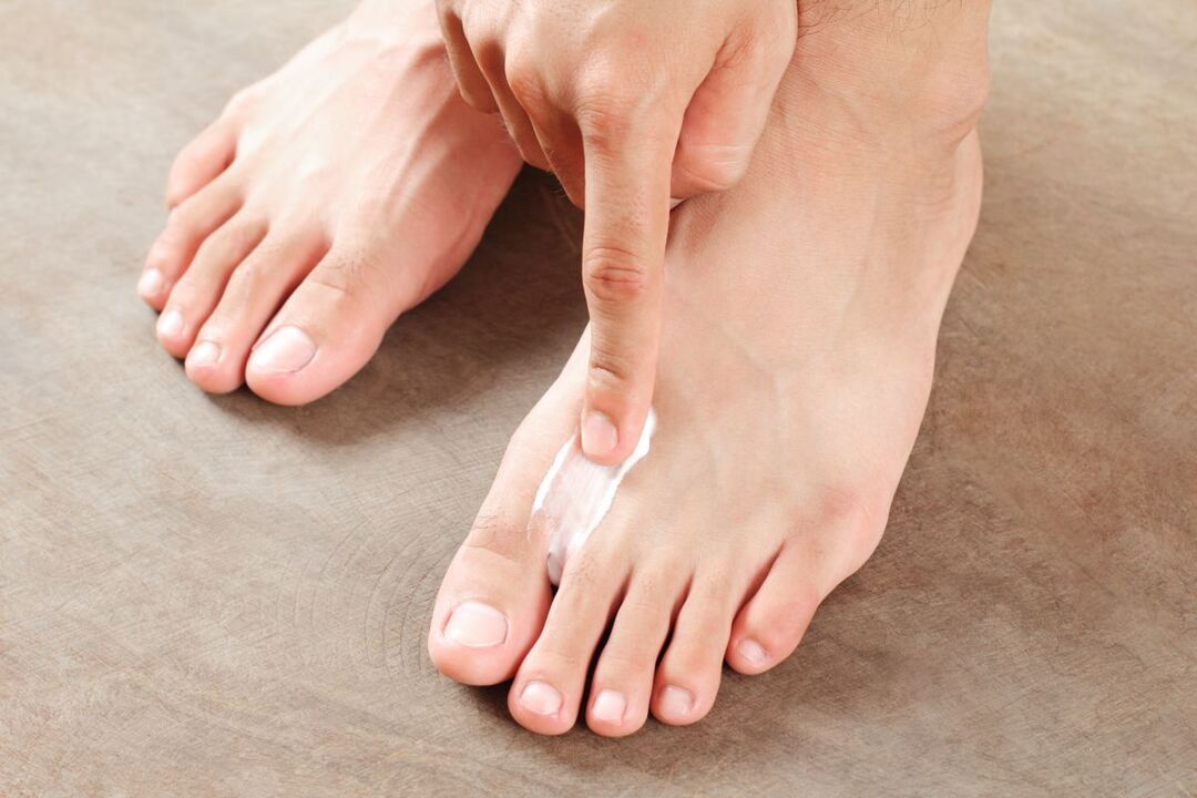 tratamiento de hongos en los pies con ungüento