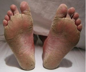 hongos en los pies como se ve