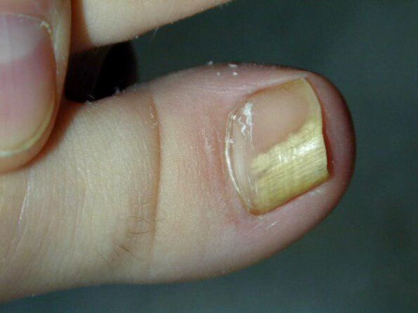 infección por hongos en las uñas de los pies