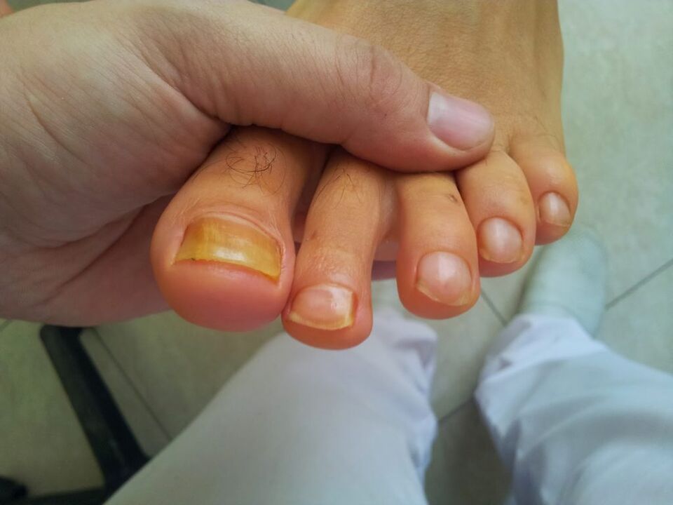 coloración amarillenta de las uñas de los pies con hongos