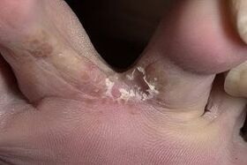 hongos en la piel entre los dedos de los pies