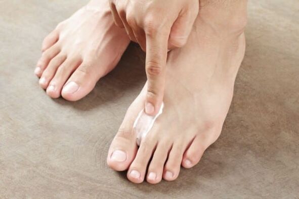 aplicación de ungüento del hongo de la piel en las piernas