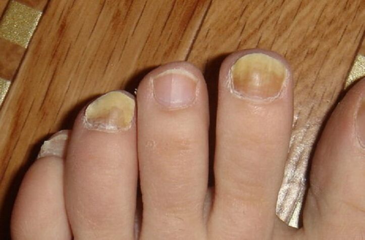 síntomas de hongos en las uñas y la piel de los pies