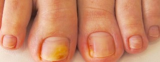 hongos en las uñas de los pies de los síntomas