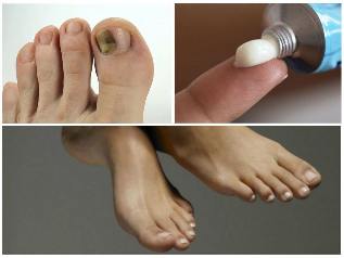 hongos en las uñas en las piernas tratamiento