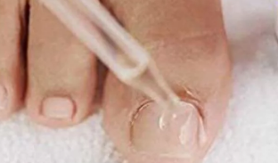 Las gotas de hongos en las uñas de los pies