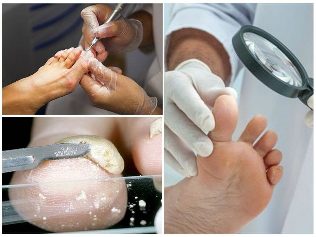 el hongo de la piel de los pies diagnóstico