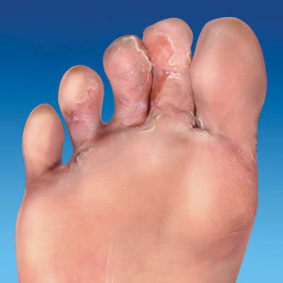 el hongo de la piel de los pies