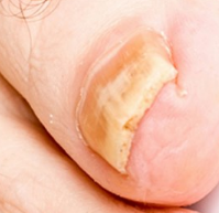 La uña del dedo afectado por el hongo