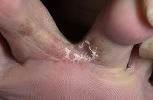 formas de hongos en los pies