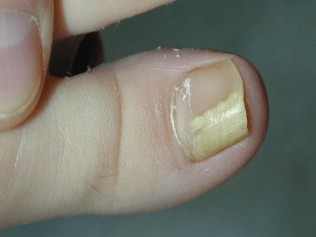 el hongo en el dedo pulgar de la pierna